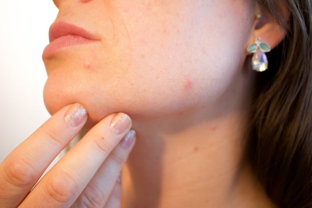 Akne behandling - Finn veien til klar hud